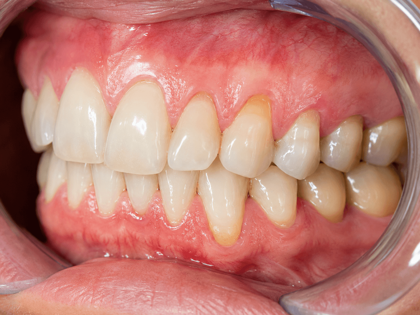 Menopauza dhe shëndeti oral detail 2