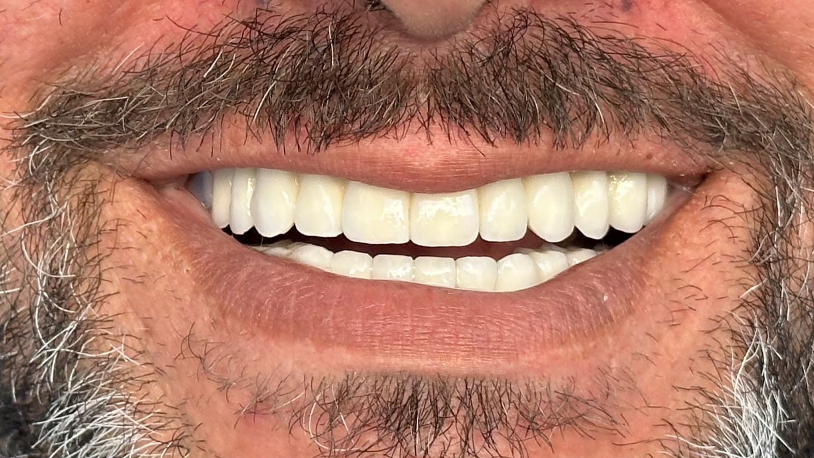 Dental implants smile case close-up