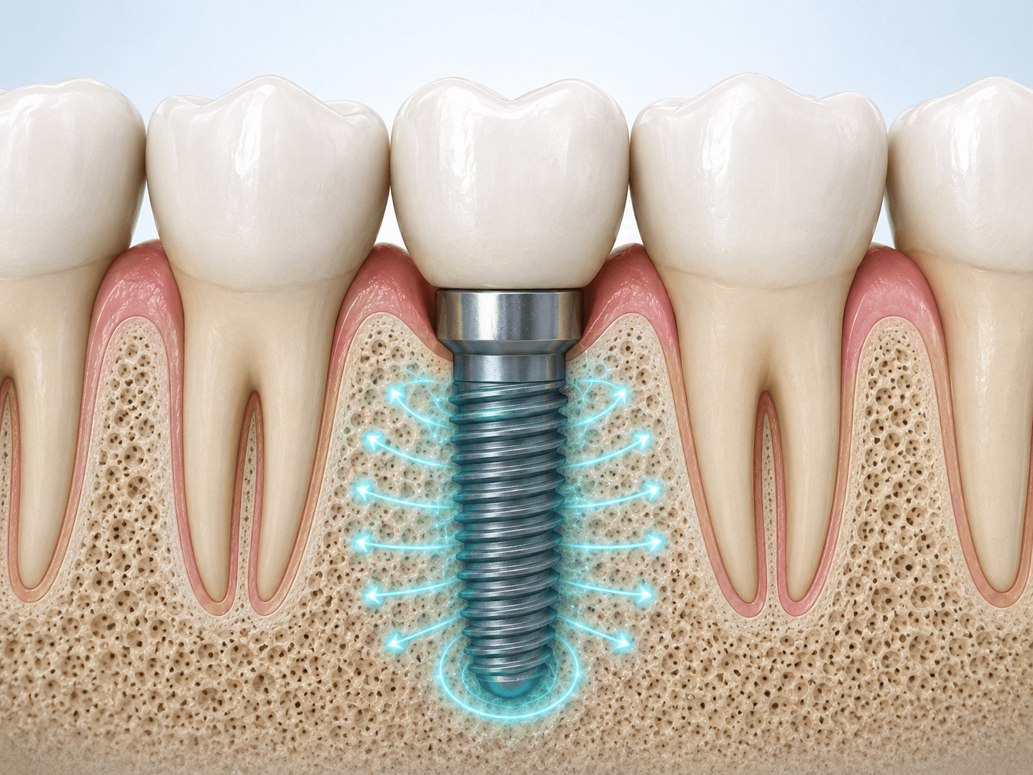 The secret to bone health: why implants are better for the jaw than dental bridges detail 1